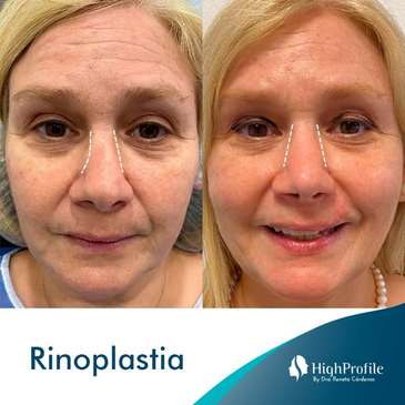 Slider image (7) Dra. Renata Cardenas-Aesthetic & Fuctional Rhinoplasty